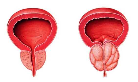 Prostată normală și inflamată (prostatita)