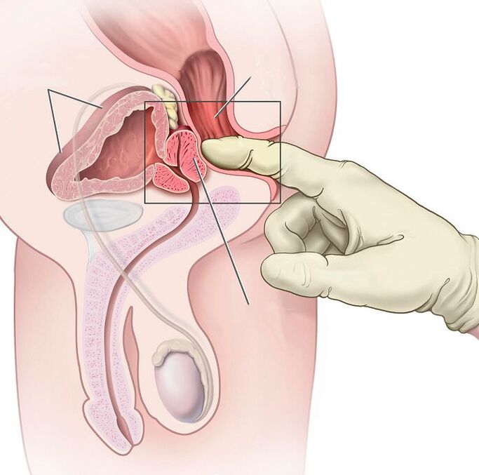 Masaj de prostată pentru tratamentul prostatitei