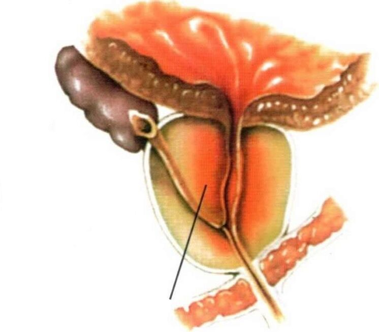 Inflamația țesutului prostatic în prostatita cronică